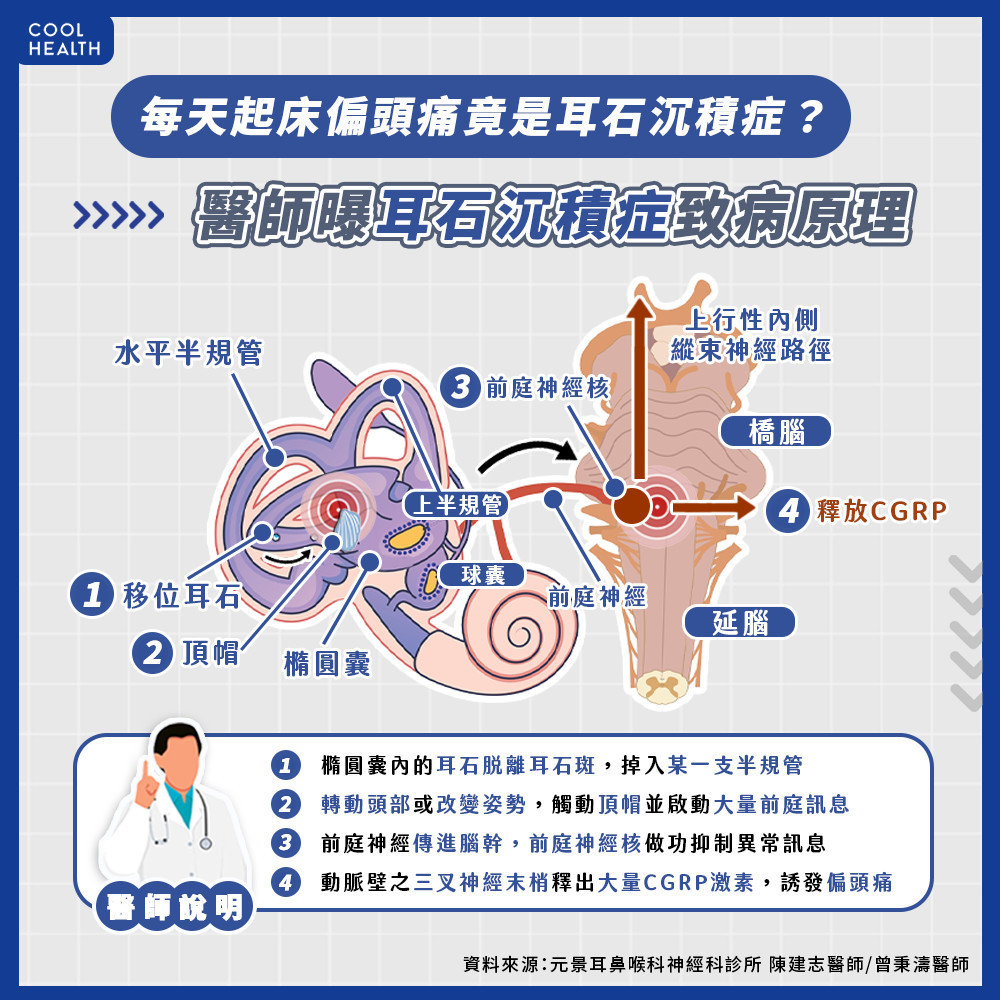 耳石掉入半規管引發偏頭痛 年長與慢性病當心