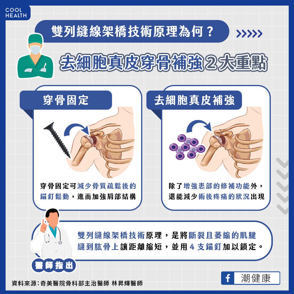 肩旋轉肌腱破裂的治療為何？ 醫曝「雙列縫線架橋」技術優勢